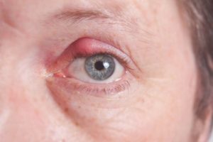 patient with chalazion bump on upper eyelid