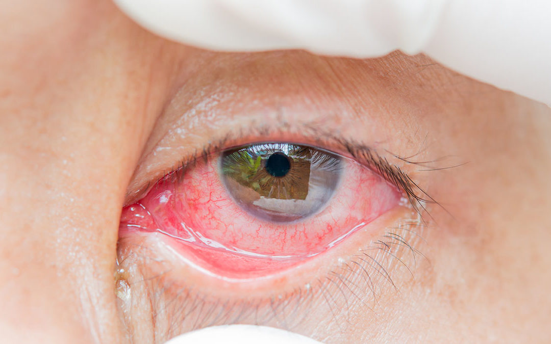 How to Identify and Treat Pink Eye