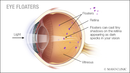 Diagram of eye floaters
