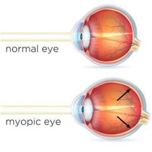 What is Myopia? | O'Fallon Family Eyecare