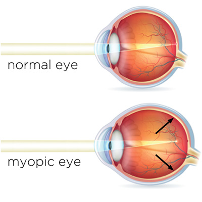 Image showing what happens to the path of light in eyes affected by myopia.