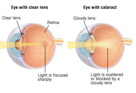 View of cataract formation