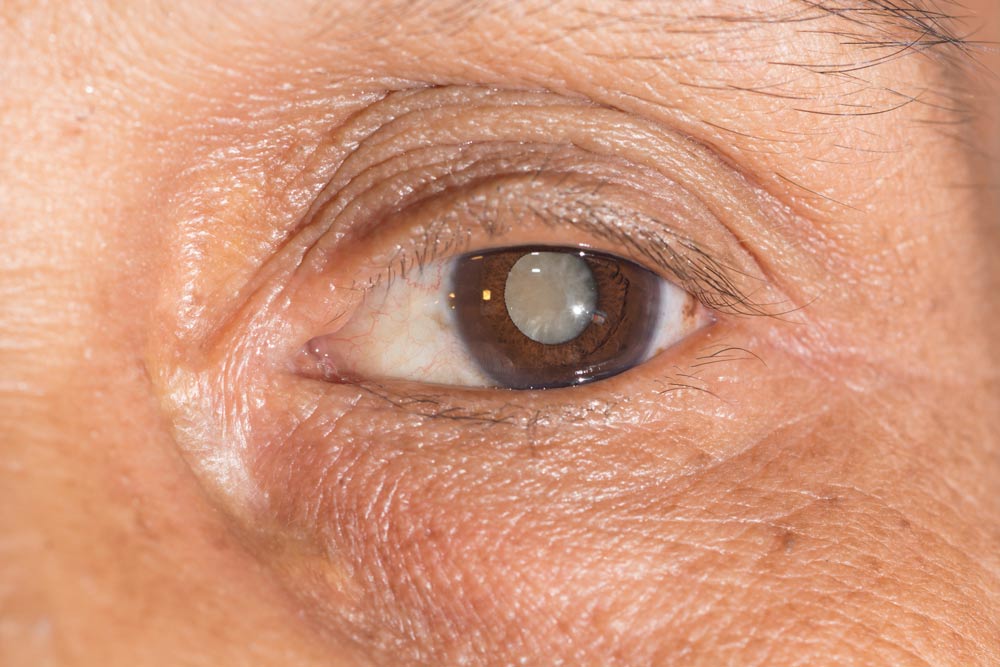 An image of someone with cataracts.