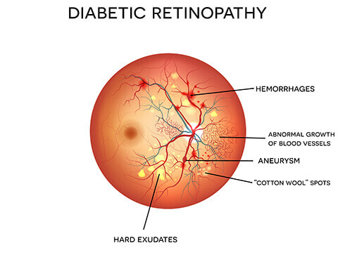 diagram of diabetic retinopahy