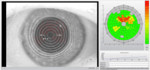 non-invasive-tear-breakup-time-oculus-keratograph